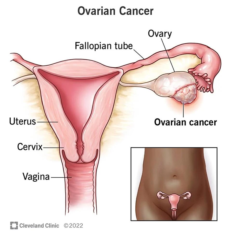 Image of tumor on an ovary 