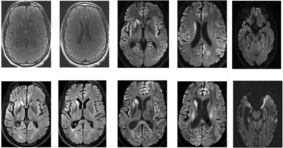 A FLAIR and Diffusion MRI scans of the horizontal sections of the brain of a 33- year old patient with sporadic Creutzfeldt-Jakob disease (Creutzfeldt-Jakob disease). Top row are MRI scans of the patient’s brain taken in April 2016. Bottom row are MRI scans of the patient’s brain taken in May 2016.