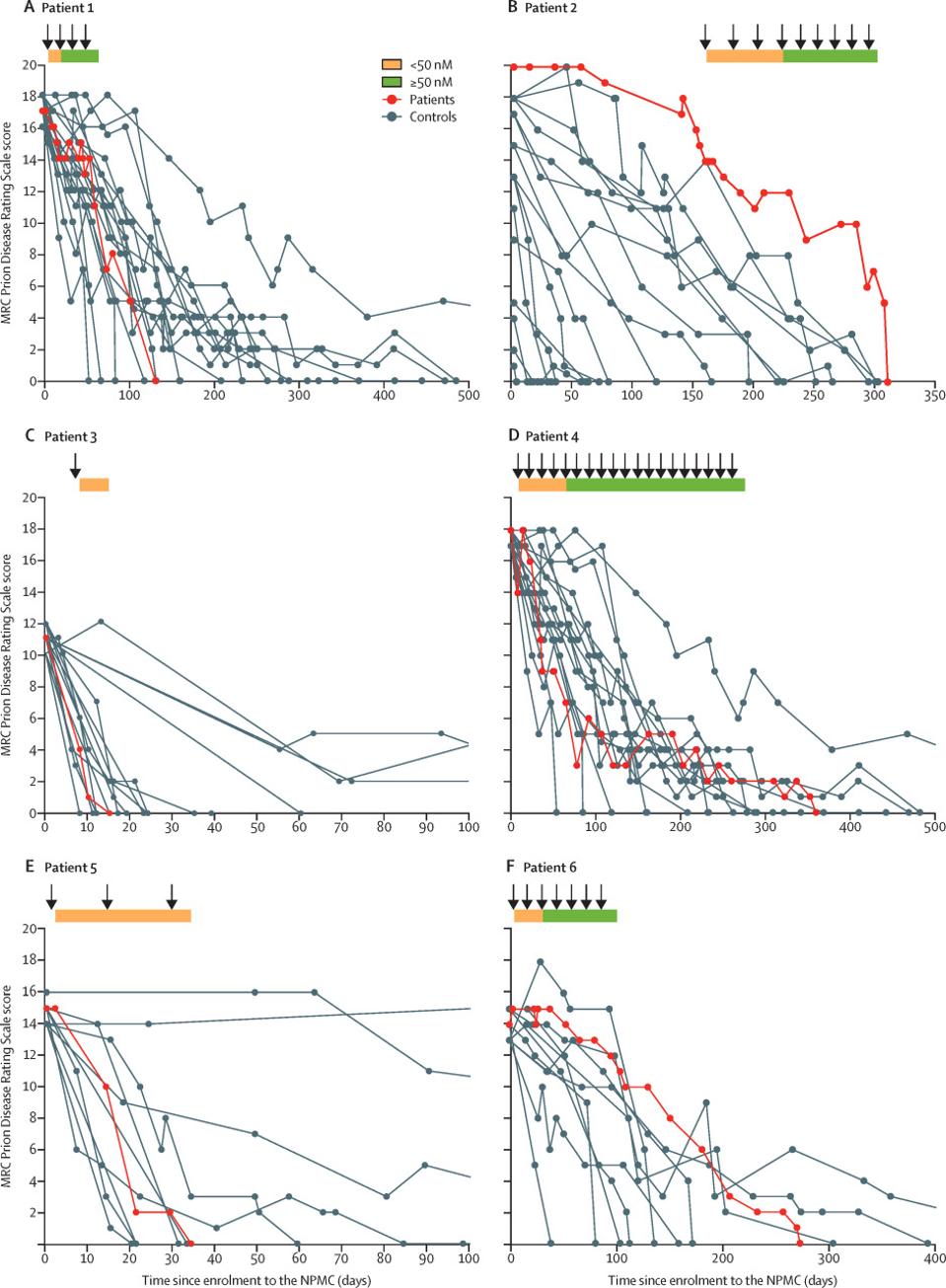 Figure 2: Patients’ MRC Prion Rating Scale scores over time (days) since enrollment. Panel (A) represents scores of patient 1(red) compared to 18 controls (gray) with sporadic Creutzfeldt-Jakob with a heterozygous genotype codon on the PRNP gene and baseline score on the MRC Prion Disease Rating Scale within 16-18. Panel (B) represents scores of patient 2 (red) to 17 (gray) controls with iatrogenic Creutzfeldt-Jakob,  any genotype codon on the PRNP gene and any score on the MRC Prion Disease Rating Scale. Panel (C) represents scores of patient 3 (red) compared to 17 controls (gray) with sporadic Creutzfeldt-Jakob, a baseline score of 10-12 on the MRC Prion Disease Rating Scale and a genotype at codon 129 in the PRNP gene. Panel (D) represents scores of patient 4 (red) compared to 18 controls (gray) with sporadic Creutzfeldt-Jakob with a score of 16-18 on the MRC Prion Disease Rating Scale and a heterozygous genotype at codon 129 on the PRNP gene. Panel (E) represents scores of patient 5 (red)  compared to 10 controls (gray) with sporadic Creutzfeldt-Jakob, a baseline score of 12-15 on the MRC Prion Disease Rating Scale, and a methionine homozygous genotype at codon 129 in the PRNP gene. Panel (F) represents scores of patient 6 (red) to 10 controls (gray) with sporadic Creutzfeldt-Jakob, a baseline score of 13-15 on the MRC Prion Disease Rating Scale, and a heterozygous PRNP genotype at codon 129 in the PRNP gene. The orange bar represents a concentration lower than 50nM of the PRN100 antibody in the cerebrospinal fluid. The  orange bar represents a concentration equal to or greater than 50nM of the PRN100 antibody in the cerebrospinal fluid. 