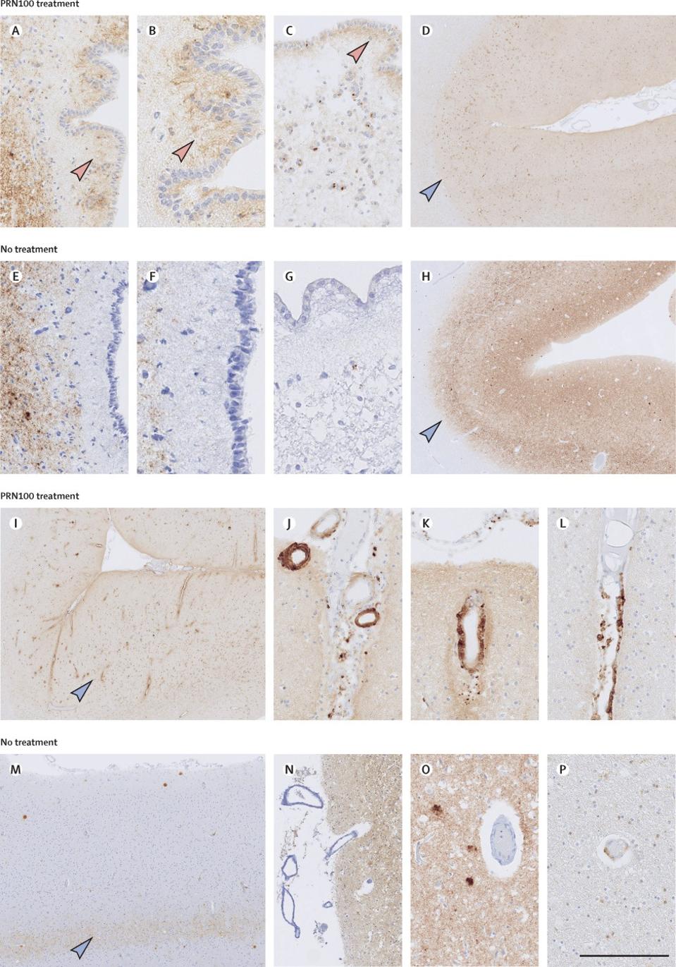 Figure 3: The impact of PRN100 on the removal of PrPSc from the brain. Panels A-D come from PrP labeling in the brain of PRN100 treated patient 2. Panels E-H are PrP labeling of the brain of an untreated patient with iatrogenic Creutzfeldt-Jakob.  Panels I-L compare the optical region of the PRN100-treated brain of patient 2. Panels M-P compare the optical region of the non-treated brain of a patient with iatrogenic Creutzfeldt-Jakob.