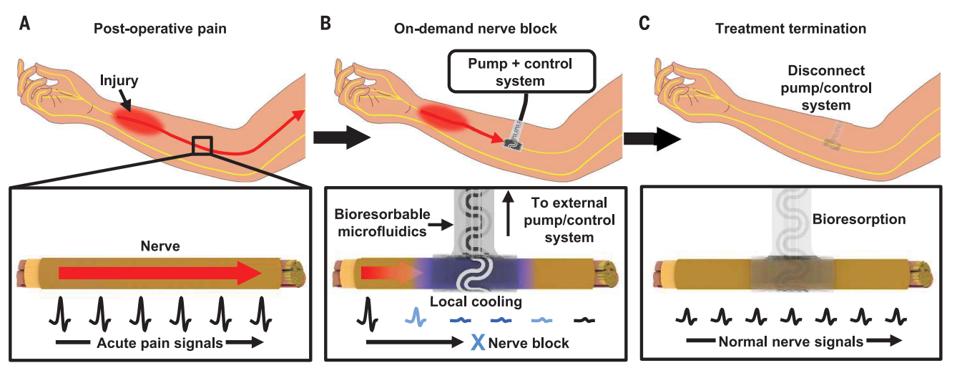 Figure 1: The implant wraps around specific nerves for specific, localized cooling.