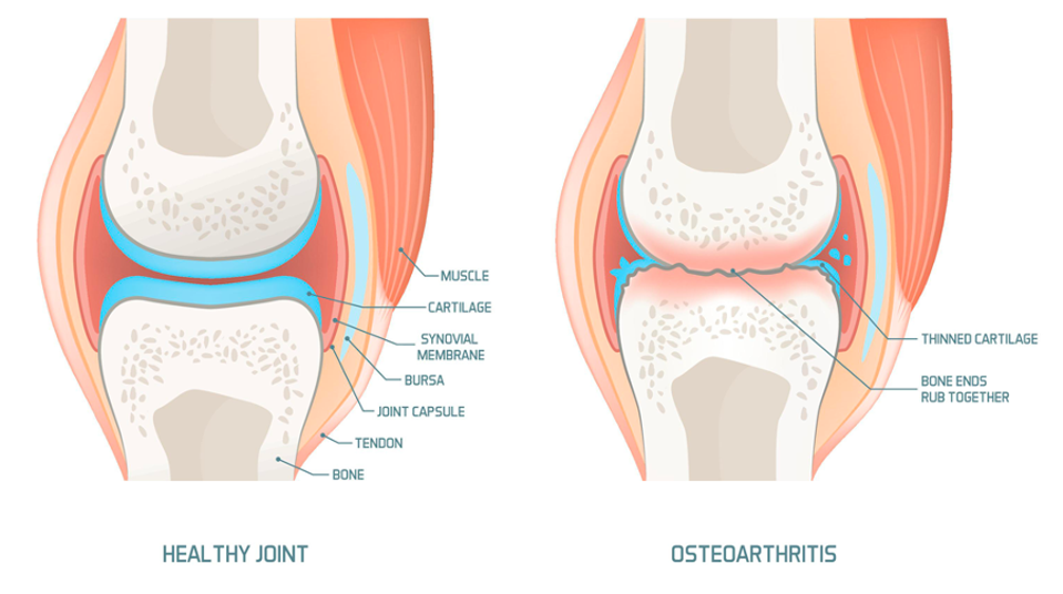 Joint with Osteoarthritis
