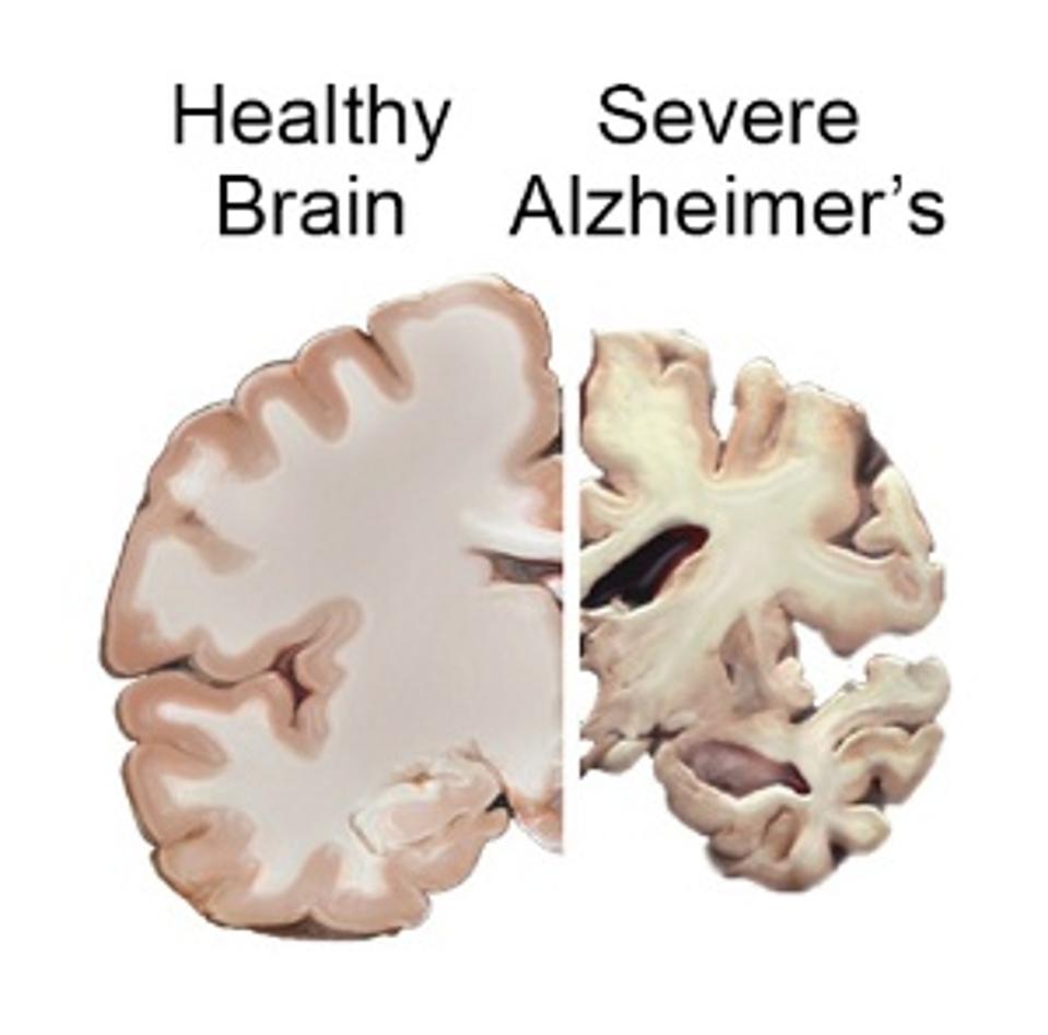 Alzheimer's causes severe brain atrophy.