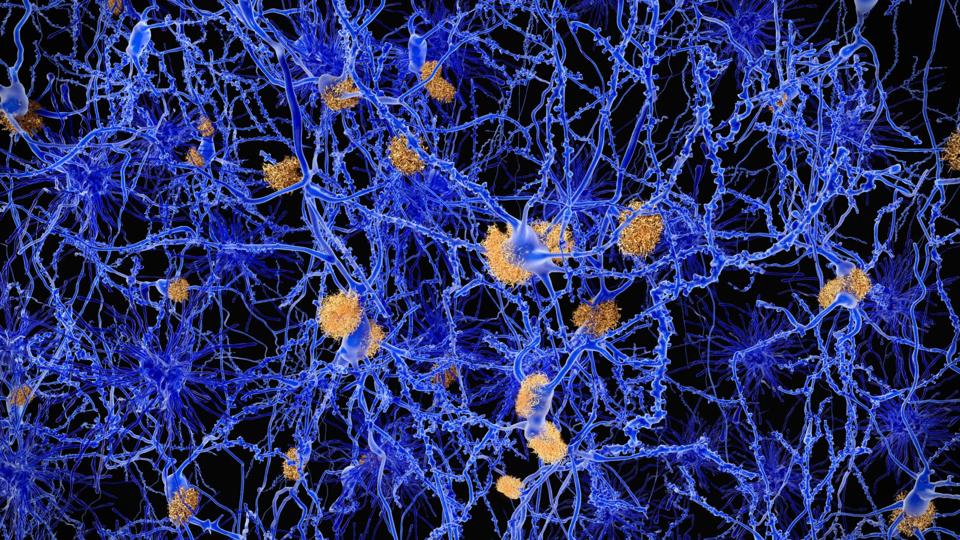 Alzheimer's is linked to the formation of amyloid plaques in the brain.