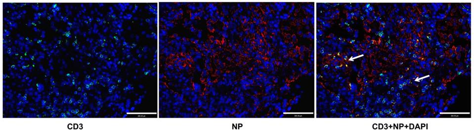 Figure 1: Patients displayed elevated T lymphocytes. Many T cells exhibited infection.